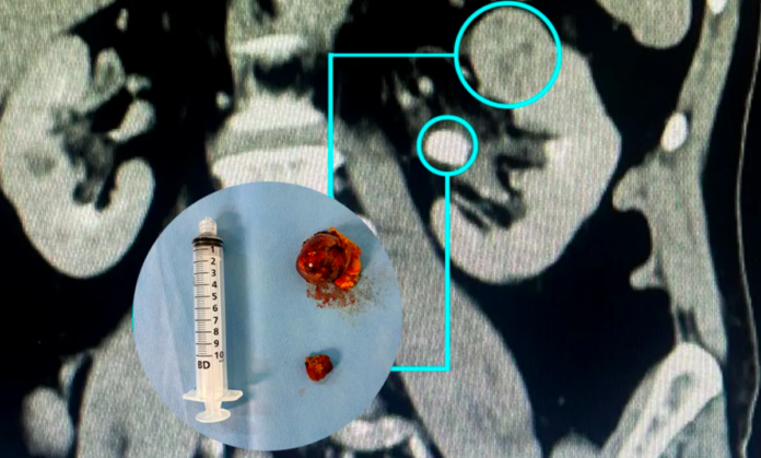 Nefrectomia robótica preserva rins com alta precisão